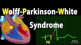 WolffParkinsonWhite Syndrome Pathophysiology PreExcitation and AVRT Animation [upl. by Teik]