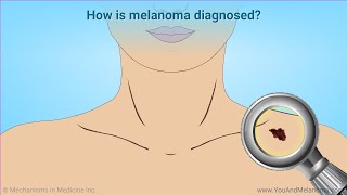 Diagnosing Melanoma [upl. by Mata904]