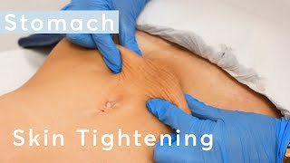 Skin Tightening Stomach  HIFU Ultraformer III Treatment [upl. by Obala]