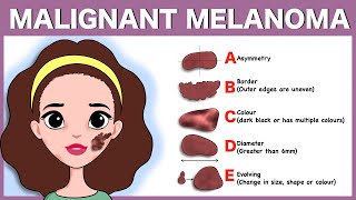 The Basics of Melanoma 5 Ws [upl. by Ayokal990]