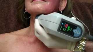 Exilis on Face amp Neck for Skin Tightening with Dr Seiler [upl. by Trip]