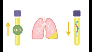 Differentiating transudative and exudative effusions transudate vs exudate [upl. by Lonna]