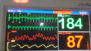 Supraventricular TachycardiaSVT in Cardiac Monitor [upl. by Feigin510]