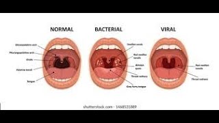 Pharyngitis Part 1 Viral Pharyngitis [upl. by Nnylrebma]