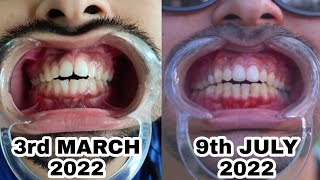 Toothsi Aligners Honest Review 🤐😬 [upl. by Rafaela209]