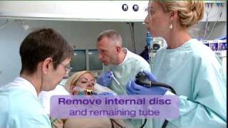 PEG removal and placement preparation cuBBy button [upl. by Kciremed]