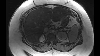 Hepatic Steatosis [upl. by Salb]