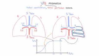 VQ mismatch [upl. by Morrill838]