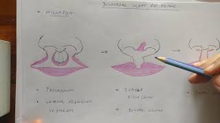 Maxs Story Cleft Lip and Palate [upl. by Duarte]