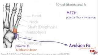 5th Metatarsal Fractures [upl. by Llerrem]