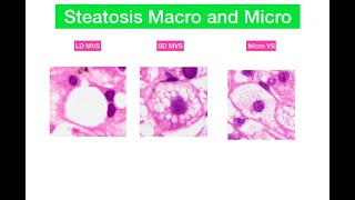 Macro and microvesicular steatosis in liver [upl. by Haukom638]