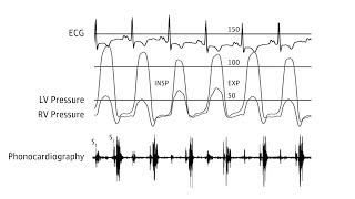 Myocarditis  causes pathophysiology investigation and treatment [upl. by Newel612]