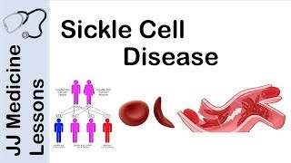 Sickle Cell Disease  Pathophysiology Symptoms and Treatment [upl. by Edwin]