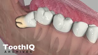 Impacted Tooth Removal [upl. by Drol]