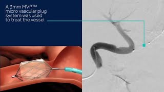 Discover Medtronics MVP™ micro vascular plug System and Concerto™ detachable coil system [upl. by Tymothy]