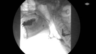 Modified Barium Swallow Test [upl. by Riffle347]