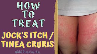 HOW TO TREAT JOCKS ITCH  TINEA CRURIS [upl. by Silrak90]