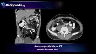 Appendicitis  Symptoms Of Appendicitis Causes Of Appendix Pain [upl. by Idieh]