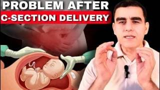 Problems After Cesarean  डिलीवरी के बाद होने वाली प्रॉब्लम्स  C Section Complications [upl. by Fields]