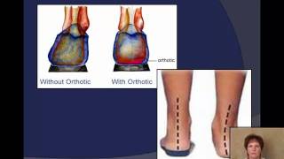 Plantar fasciitis Signs symptoms and treatment options [upl. by Deeas382]