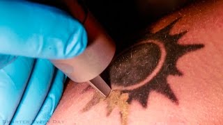 How Laser Tattoo Removal Works  Smarter Every Day 123 [upl. by Ardnal326]