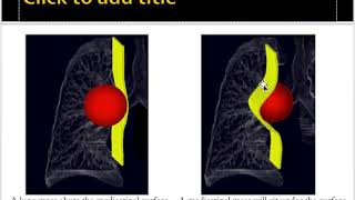 Mediastinal masses approach [upl. by Erich483]