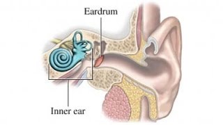 Meniere Disease [upl. by Meadow677]