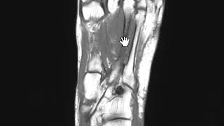 Metatarsal stress fracture by MRI [upl. by Teak38]