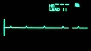 Primary Ventricular Standstill P wave Asystole [upl. by Agnese125]