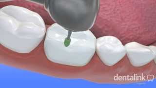 INCRUSTACIÓN dental  Video 3D paso a paso [upl. by Anailuj285]