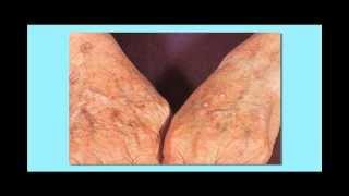 Actinic Keratosis Precancerous Skin Cancer [upl. by Hernardo]