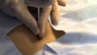 Biopsy Procedure Overview Dermatology [upl. by Wallie]