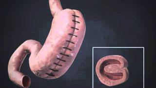 Gastric Sleeve Plication Total Gastric Vertical Plication Laparoscopic Greater Curvature Plication [upl. by Edmanda]