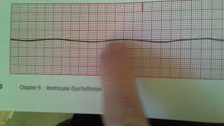 Agonal and Asystole [upl. by Noirb673]