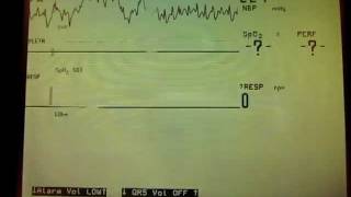 Asystole Apnea alarms [upl. by Imre291]