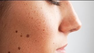 What Are the Signs of Skin Cancer [upl. by Aslam]