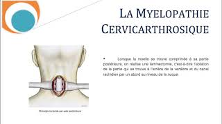 La Myélopathie Cervicathrosique Cervicarthrosis Myelopathy SFCR [upl. by Hildegard]