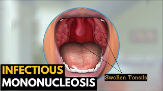 Infectious mononucleosis Causes Signs and Symptoms Diagnosis and Treatment [upl. by Auqinu255]