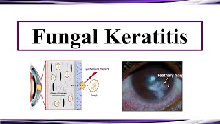 Fungal Keratitis [upl. by Coulson662]