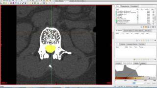 Materialise Mimics and 3Matic Tutorial [upl. by Colfin]