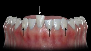 How Buttons Help Clear Aligners [upl. by Nossila411]