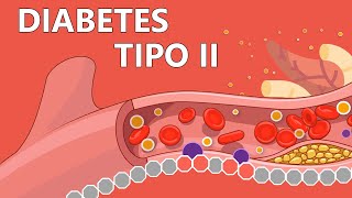 Diabetes tipo 2  Explicada Fácilmente Para Pacientes [upl. by Ahsekyt]