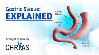 Gastric Sleeve Explained [upl. by Haduj345]