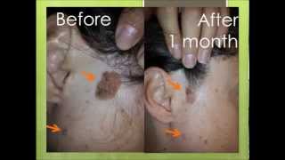 Natural treatment for seborrheic keratosis before and after photos [upl. by Rainer]