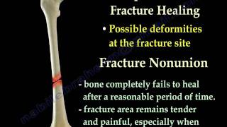 Fracture Healing Part 1  Everything You Need To Know  Dr Nabil Ebraheim [upl. by Ijuy]