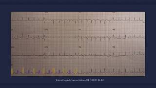 Electrical Alternans ECG [upl. by Zack]