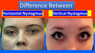 Horizontal Nystagmus Vs Horizontal Nystagmus [upl. by Setiram110]