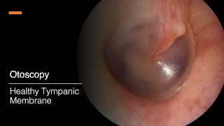 Tympanic Membrane Otosopy [upl. by Elinore]