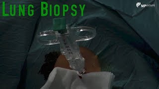 Kidney biopsy procedure [upl. by Noslien431]