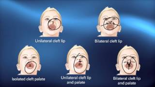 NAM Device for Cleft Lip with Plastic Surgeon Dr Matthew Trovato [upl. by Adnolahs702]